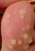 Pedicuren, wratbehandeling, steunzolen