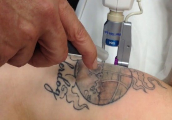 Laat uw tattoo weglaseren door de specialist van Nederland! — foto 2