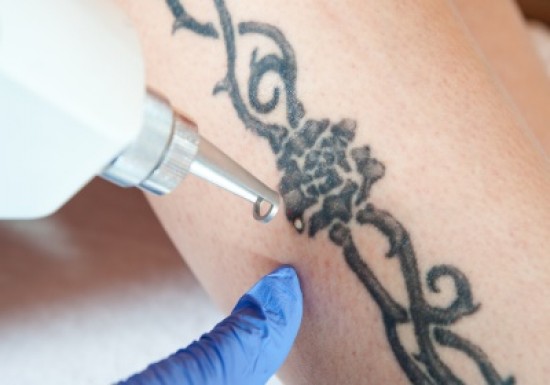 Tattoo weg laten halen door de specialist van Nederland! — foto 2