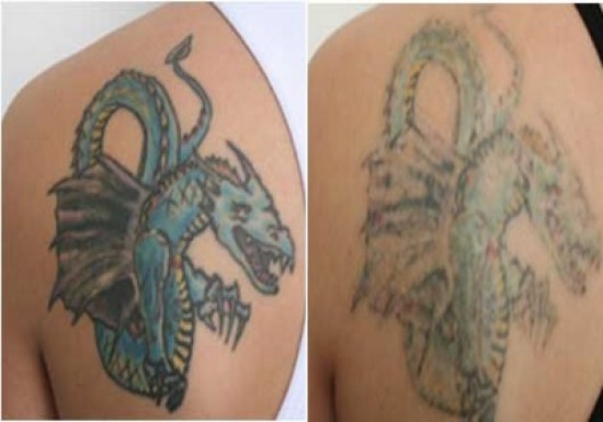 Tattoo weg laten halen door de specialist van Nederland! — foto 3
