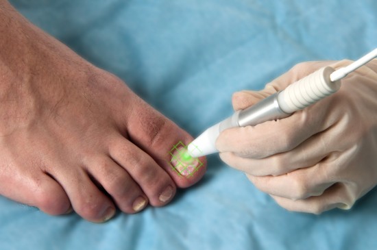 Last van kalknagels? Laserbehandeling voor gezonde en heldere nagels — foto 3