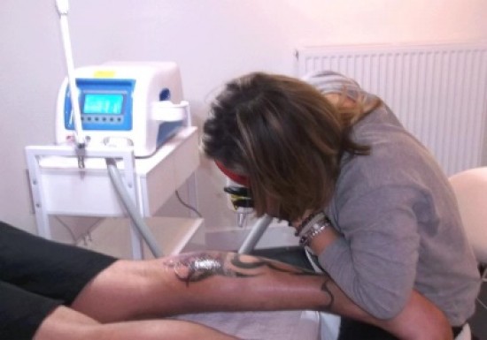 Laat uw tattoo verwijderen door een specialist! — foto 3